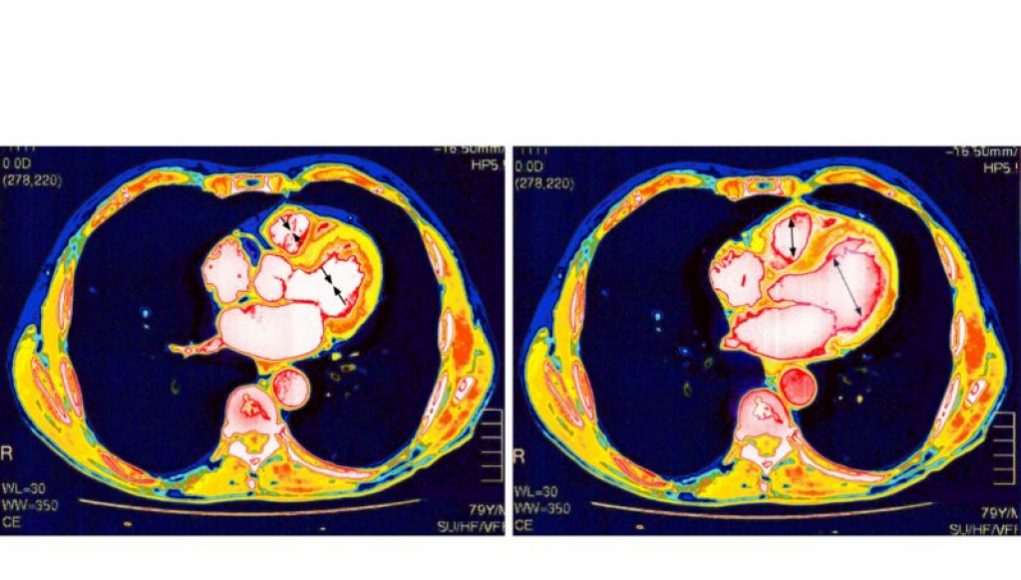 Uncovering the Mystery: Study Excludes Common Causes of Rare Myocarditis Post COVID Vaccination