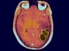 Brain Abscesses in US Children Increase as COVID Restrictions Ease Brain Abscesses in US Children Increase as COVID Restrictions Ease