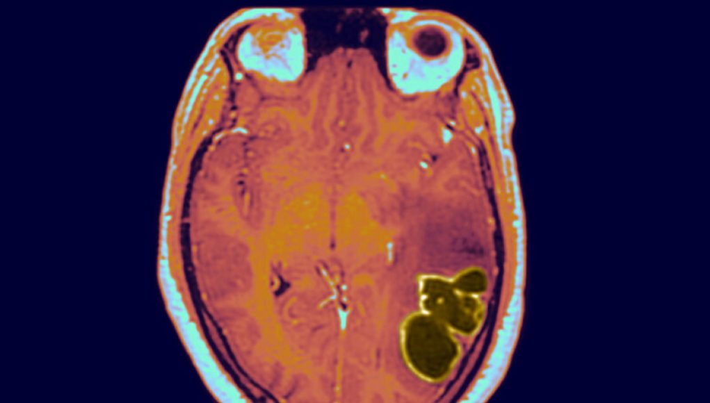 Brain Abscesses in US Children Increase as COVID Restrictions Ease