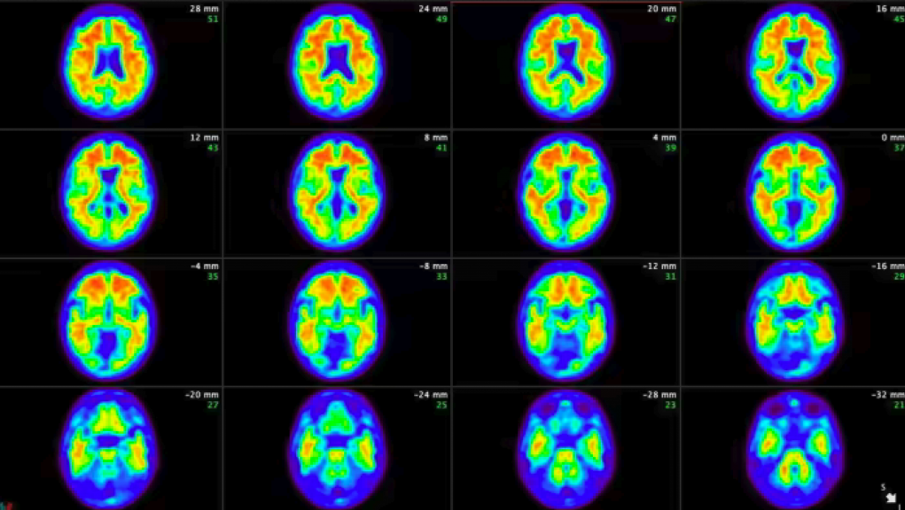 Eli Lilly’s Medication Demonstrates Ability to Delay Alzheimer’s Progression