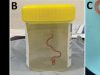 Woman Discovers 3-Inch Snake Parasite in Her Brain After Suffering from Mysterious Illness Woman Discovers 3-Inch Snake Parasite in Her Brain After Suffering from Mysterious Illness