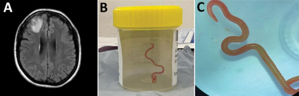 Woman Discovers 3-Inch Snake Parasite in Her Brain After Suffering from Mysterious Illness