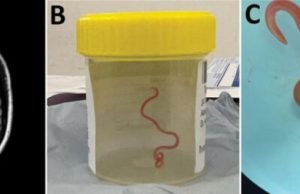 Woman Discovers 3-Inch Snake Parasite in Her Brain After Suffering from Mysterious Illness Woman Discovers 3-Inch Snake Parasite in Her Brain After Suffering from Mysterious Illness